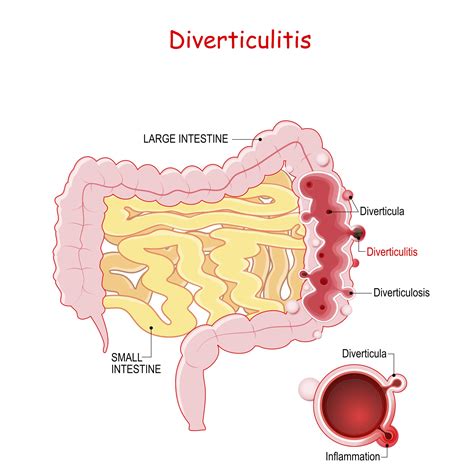Diverticulitis 醫學